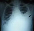Massive pleural effusion, later proven to be hemothorax, in a South Indian male