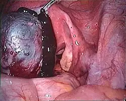 a silvery-brown endometrioma releasing dark brown fluid