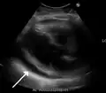 Ultrasounds showing a pericardial effusion in someone with pericarditis