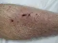 Petechia of the lower leg in a person with platelets of 3 due to ITP