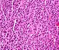 Plasmacytoma, H&E stain