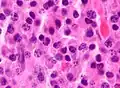 Micrograph of a plasmacytoma, H&E stain