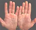 Psoriasis of the palms