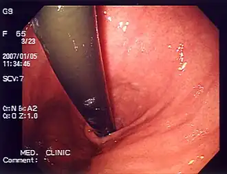 Endoscopic photo of the stomach