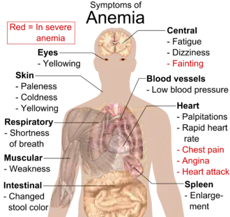 Chart listing symptoms of anemia and locating them to areas of the body. Eyes: yellowing. Skin: paleness, coldness, yellowing. Respiratory: shortness of breath. Muscular: weakness. Intestinal: changed stool color. Central: fatigue, dizziness; in severe cases fainting. Blood vessels: low blood pressure. Heart: palpitations, rapid heart rate; in severe cases chest pain, angina, heart attack. Spleen: enlargement.