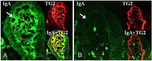 Biopsy of the intestines of someone with coeliac disease showing antibody deposits