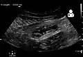Ultrasound showing appendicitis and an appendicolith.[62]