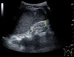 End-stage chronic kidney disease with increased echogenicity, homogenous architecture without visible differentiation between parenchyma and renal sinus, and reduced kidney size. Measurement of kidney length on the US image is illustrated by '+' and a dashed line.[68]