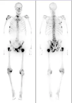 Medical image showing a man's skeleton with several dark spots along the bones