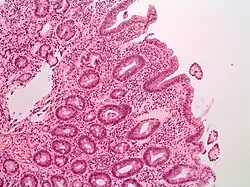 Image showing histology results from a biopsy taken from a person with coeliac disease